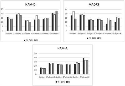 Use of 30-Hz Accelerated iTBS in Drug-Resistant Unipolar and Bipolar Depression in a Public Healthcare Setting: A Case Series